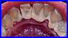 21-Yo-Female-S-Teeth-Tartar-Removal-Scaling-Dentist-Dokter-Gigi-Tri-Putra-01-ktb